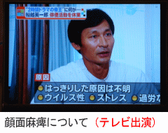 顔面神経麻痺と鍼灸