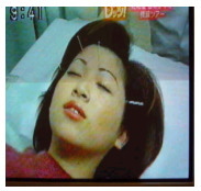 美容鍼
