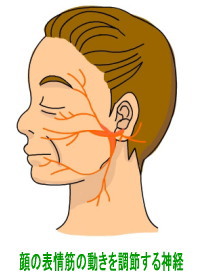 顔面神経麻痺
