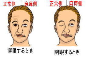 顔面神経麻痺