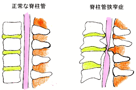 脊柱管狭窄症の正常と狭窄
