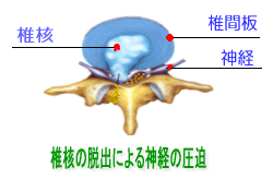 椎間板ヘルニア