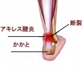 アキレス腱炎と鍼灸