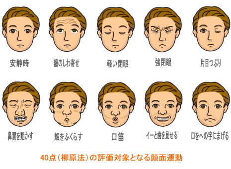 顔面神経麻痺a