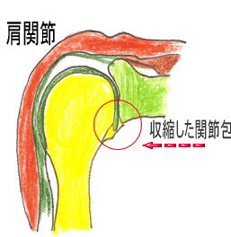 五十肩の痛み場所