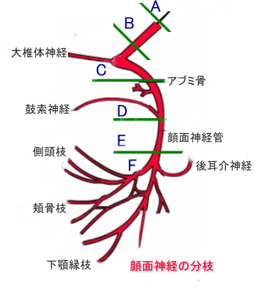 顔面神経麻痺b