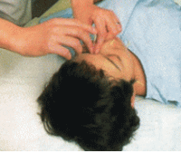 眼科疾患の鍼灸治療