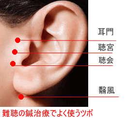 突発 性 難聴